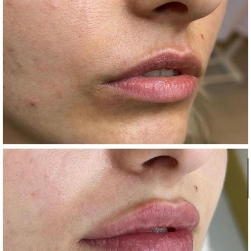 Botox Before / After photo